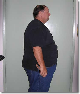Jeff Before Weight Loss Surgery