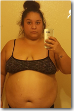 Weight Loss Surgery Patient Before and After