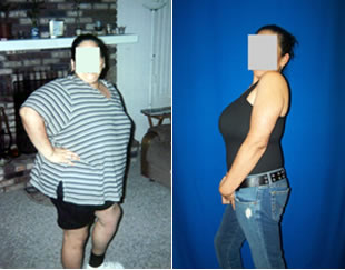 Before and After Weight Loss Surgery