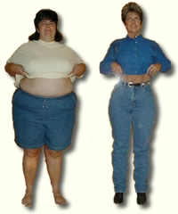 Alice Before and After Gastric Bypass Surgery