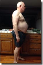 Weight Loss Surgery Patient Rich