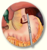 Measuring the Stomach